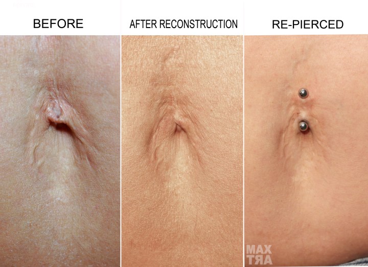 RICOPSTRUX NAVEL PIU FORO